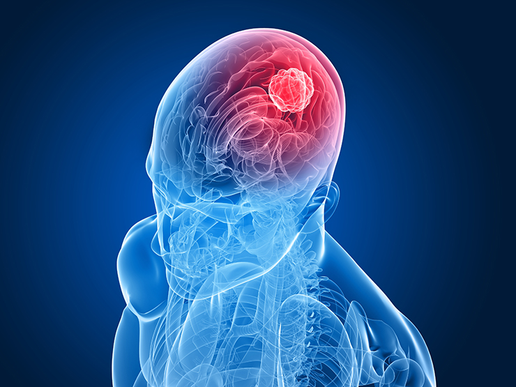 脳腫瘍は「良性」でも命取りに⁉ 早期発見に必要な検査とは