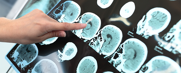 被爆と脳腫瘍の関係……何十年もかけて体を蝕む放射線の影響