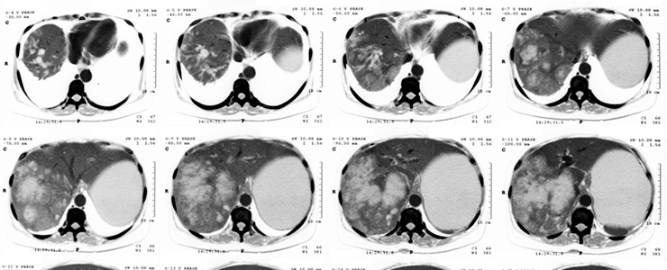 肝臓の病気は命を奪う! CTスキャンを定期的に受けよう