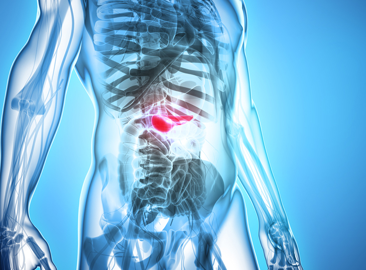 日本人のリスクが増えていると言われる「すい臓がん」とCT検査