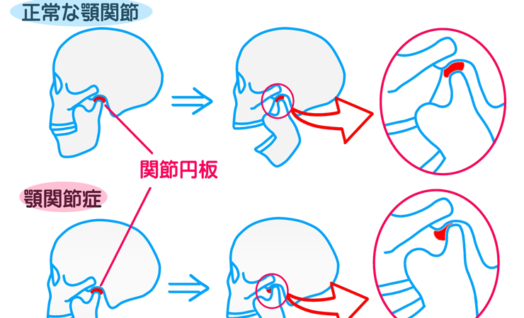 顎関節症の治療はどこで受けられる? 検査は治療の第一歩!